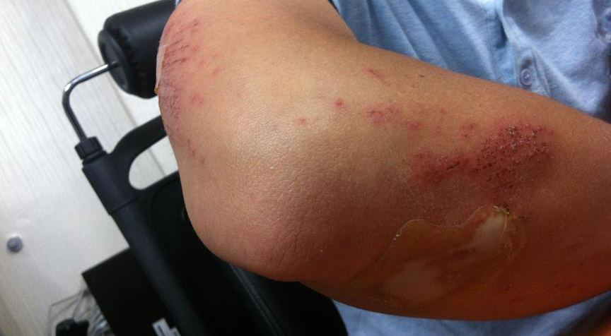 Yaraları çabuk iyileştiren bandaj geliştirildi