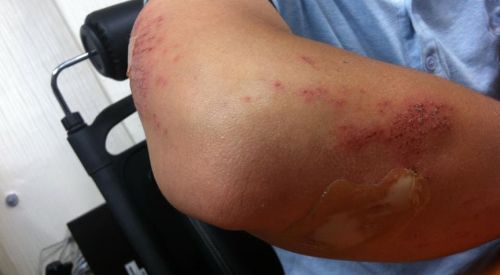 Yaraları çabuk iyileştiren bandaj geliştirildi