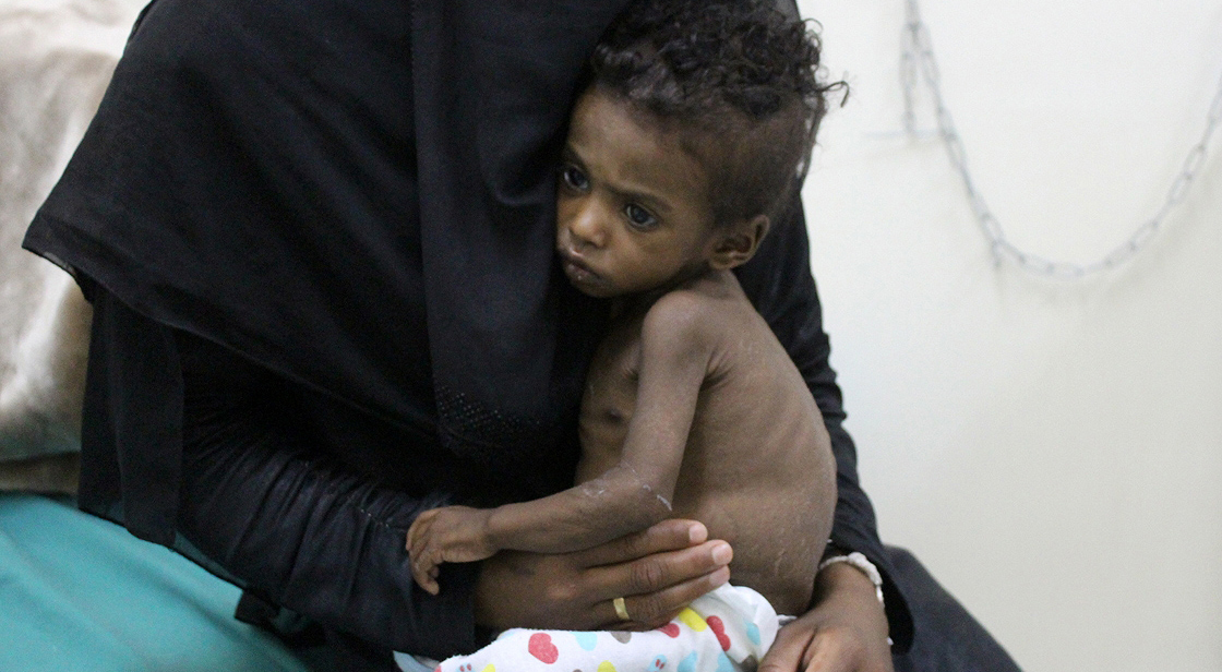 'Obezite ve beslenme yetersizliği küresel salgın'