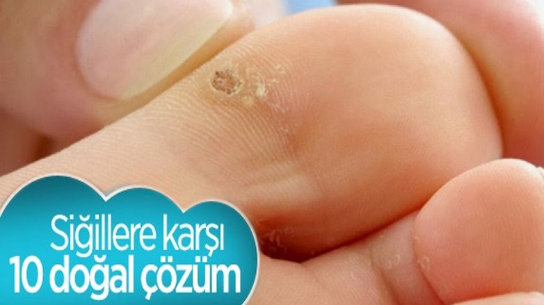 Siğilleri yok etmek için 10 doğal çözüm