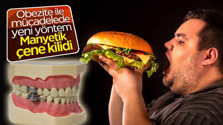 Obeziteye karşı yeni icat: Çene kilidi