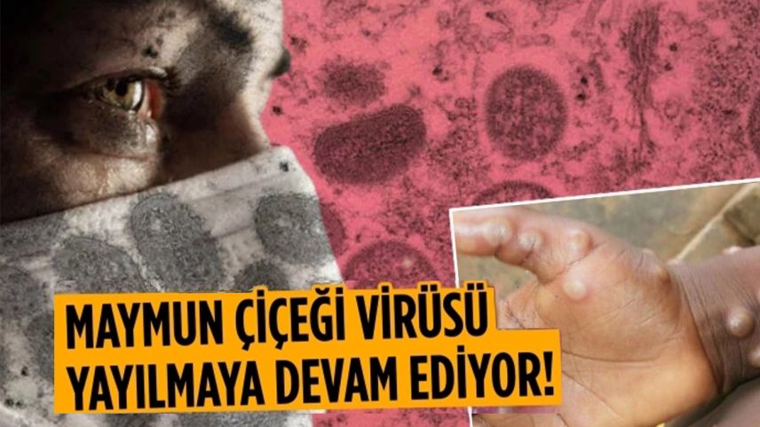 Maymun çiçeği virüsü Yunanistan'a da sıçradı!