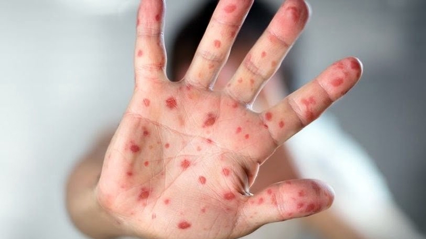 Yunanistan, artan kızamık virüsüne karşı aşı ekibi kuracak