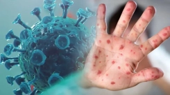 Avrupa'da M çiçeği uyarısı: Risk düşük ancak ithal vakalar artabilir