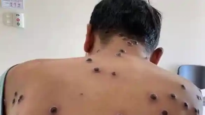 Maymun çiçeği olduğunuzu nasıl anlarsınız?