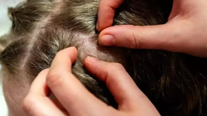 Okullar açılıyor: Bit çocuklarınızın kabusu olmasın