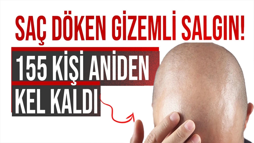 Saç döken gizemli salgın: 155 kişi aniden kel kaldı!