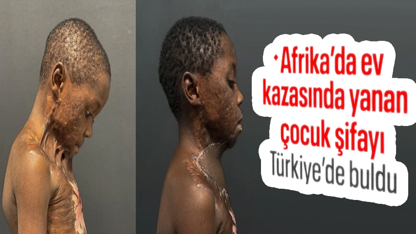 Kamerun’da boynu yanıp çenesi gövdesine yapışan çocuk Türkiye'de şifa buldu