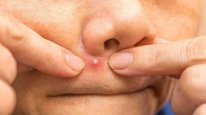 Sivilce sıkmanın sakıncaları