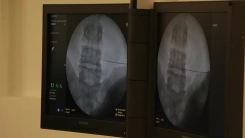 Fıtıkla yıllarca yaşamak tehlikeli mi? Uzmanlar ciddi risklere dikkat çekiyor