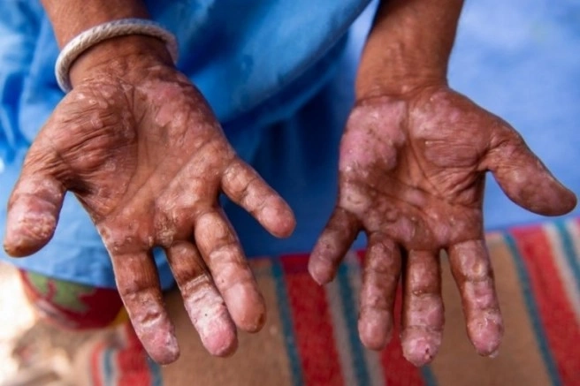 Romanya ve Hırvatistan'da 40 yılın ardından cüzzam vakaları görüldü