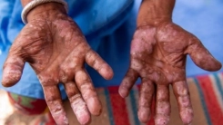 Romanya ve Hırvatistan'da 40 yılın ardından cüzzam vakaları görüldü