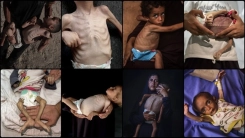 BM: Gazze'de akut yetersiz beslenme vakası 95 bine çıktı