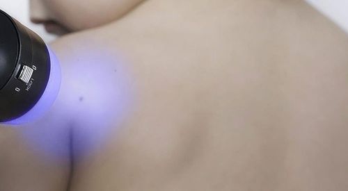 Yapay zeka cilt kanserini teşhis edebiliyor